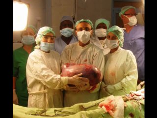 Kyste Ovarien de 15,7 kilos