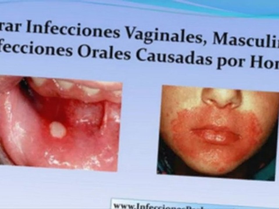 hongos genitales tratamiento - hongos vaginales tratamiento - tratamiento hongos genitales