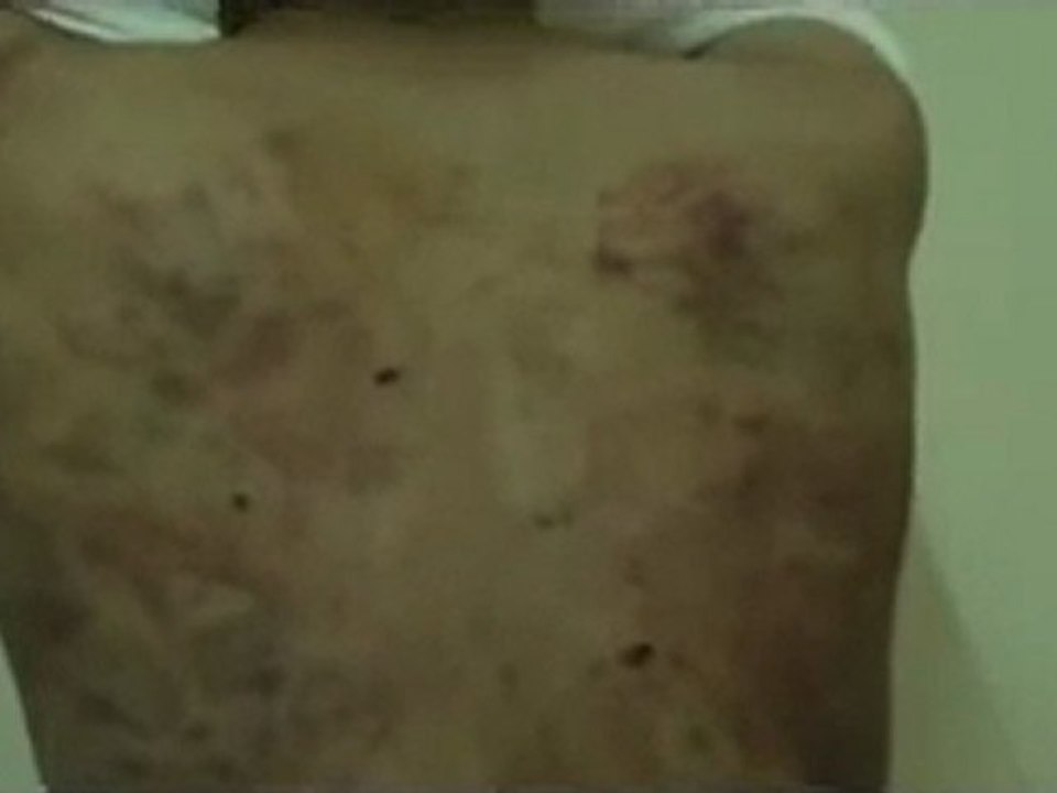 فري برس   حمص   ديربعلبة اثار التعذيب على شاب فقط لانه ديربعلبة