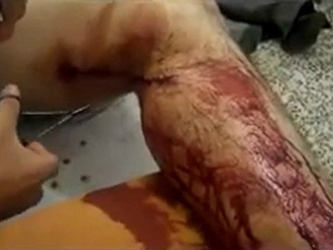 فري برس حمص البياضة من استطعنا ان نصوره من الجرحى 27 11 2011