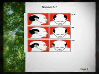 stopping hair loss for male baldness pattern   ...