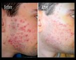 Help With Pimples Fast Way To Get Rid Of Acne How To Get Rid Of A Zit Fast Cures For Blackheads