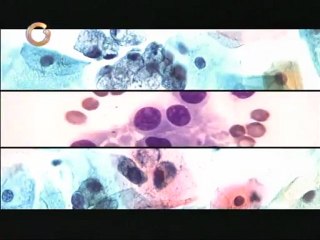 Saber Vivir: Las mujeres entre 20 y 45 años son vulnerables al cáncer de cuello uterino