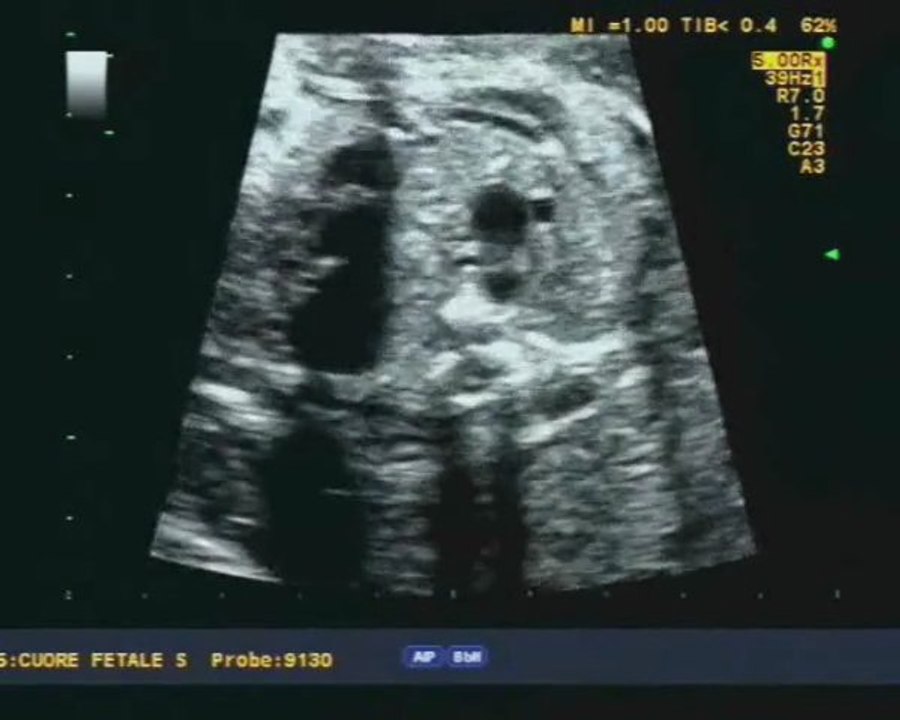 Aloka- Tetralogia di Fallot