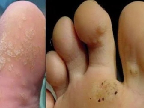 tratamiento casero para las verrugas - remedio caseros para las verrugas - eliminación de verrugas