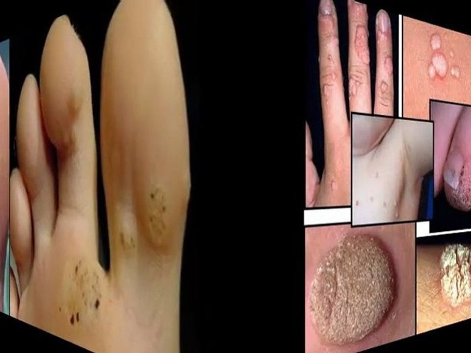 eliminar manchas acne - eliminar manchas rostro - quitar las manchas de la piel