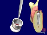 002 Implantes Dentales -Prokinetic - Quantum – Inserción Implante