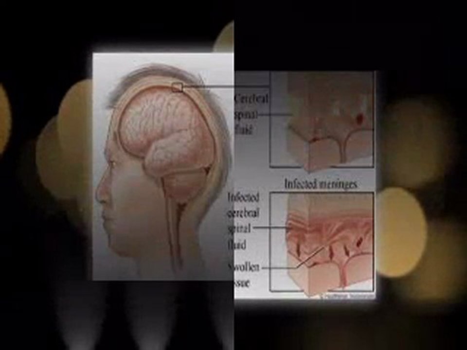 Symptoms of Bacterial Meningitis To Know