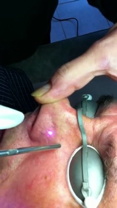 Couperose des ailes du nez traitée au laser