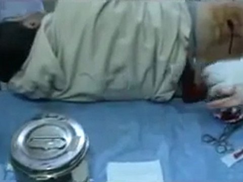 فري برس حمص باباعمرو جريح في الظهر برصاص قناصة 5 2 2012