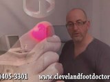 Laser for Ingrown Toenails, Warts - Cleveland, Twinsburg and Lakewood, OH