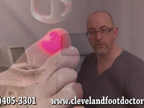 Laser for Ingrown Toenails, Warts - Cleveland, Twinsburg and Lakewood, OH
