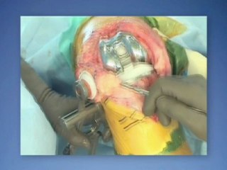 Gap Balanced Total Knee Arthroplasty - SIGMA® with AOX™