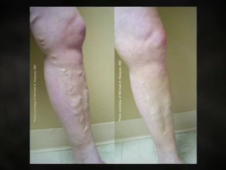 Undergoing a Mommy Makeover Surgery