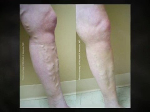 Undergoing a Mommy Makeover Surgery