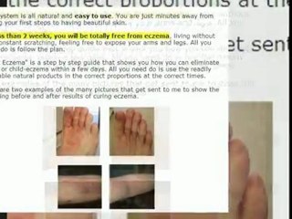 Atopic Dermatitis Treatment