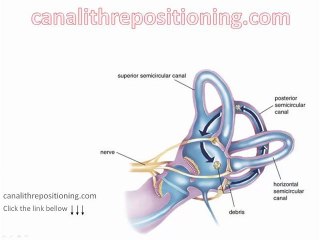 BPPV canalithrepositioning BPPV