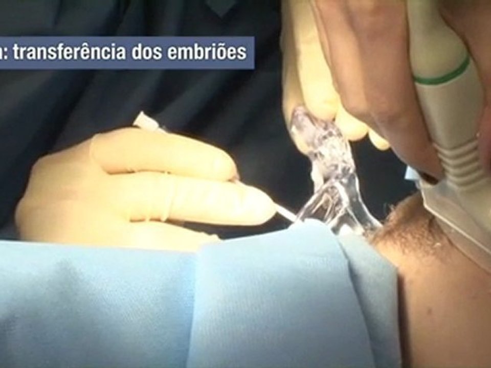 Fertilização in vitro: indicações e complicações