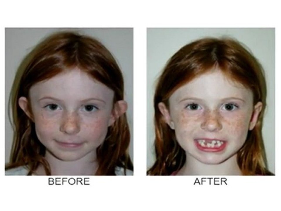 Ear Surgery (Otoplasty) Newport Beach|Dr Michael Sundine