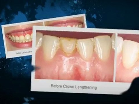 Laser Gum Therapy Seattle