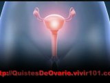 Tratamiento De Ovarios Poliquísticos Síntomas – Curar Quistes De Ovario – Quistes Ováricos