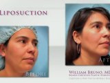 Liposuction Beverly Hills| Dr William Bruno