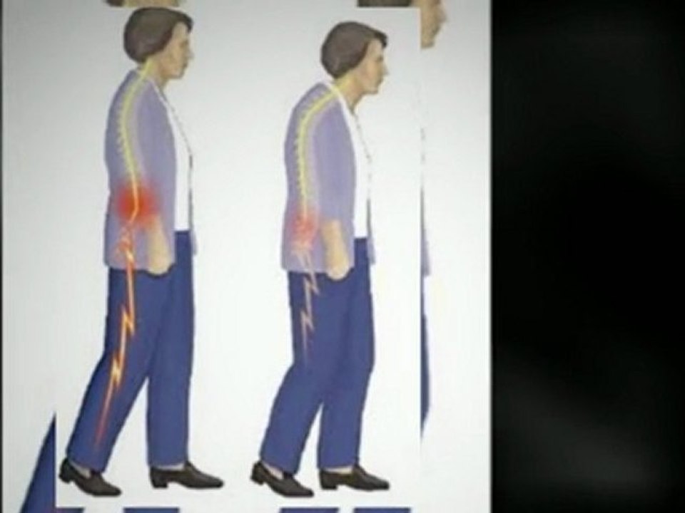 Spinal stenosis? need help?