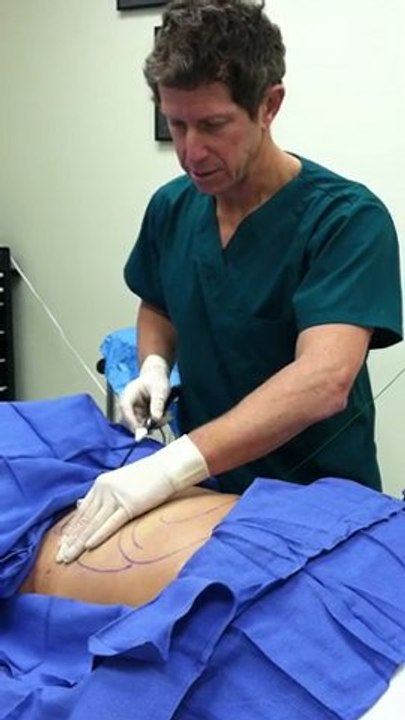 Smartlipo4
