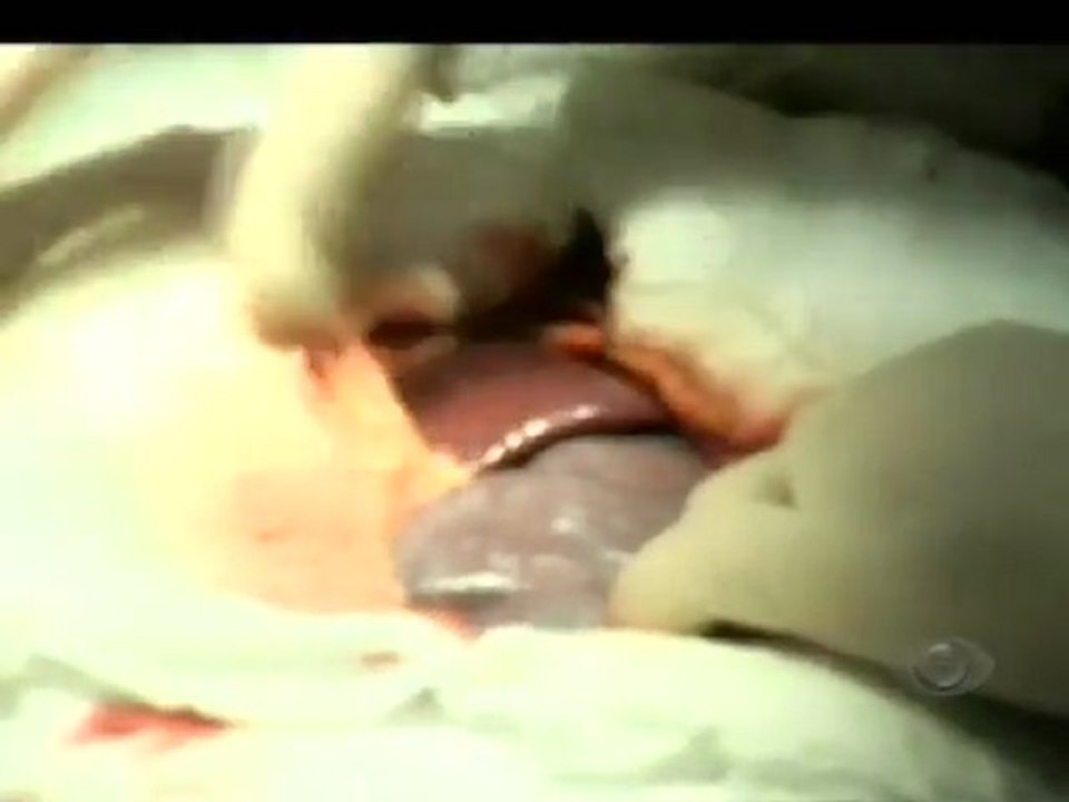 Retirada do baço