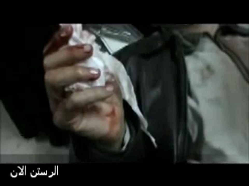 فري برس   حمص الرستن مصاب بسبب القصف المدفعي 15 2 2012