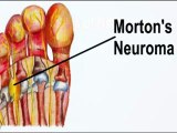 Morton's Neuroma - Podiatrist Frederick, Germantown and Hagerstown, MD