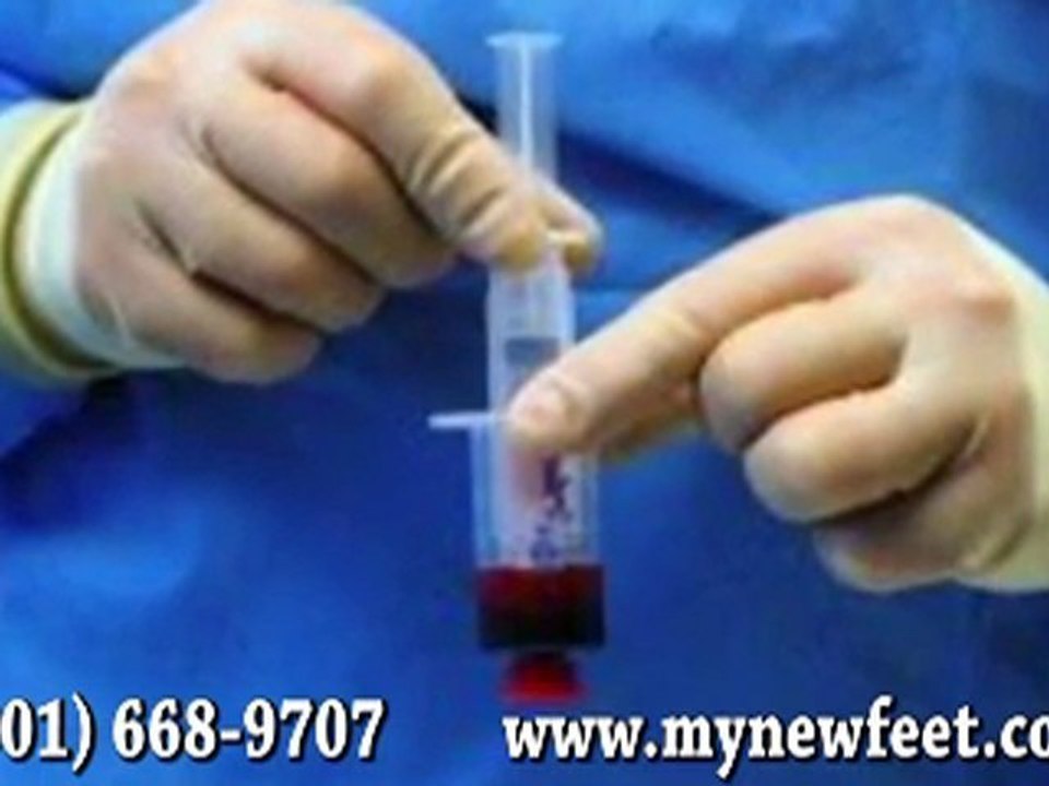 Platelet Rich Plasma (PRP) Therapy - Podiatrist Frederick, Germantown Hagerstown, MD