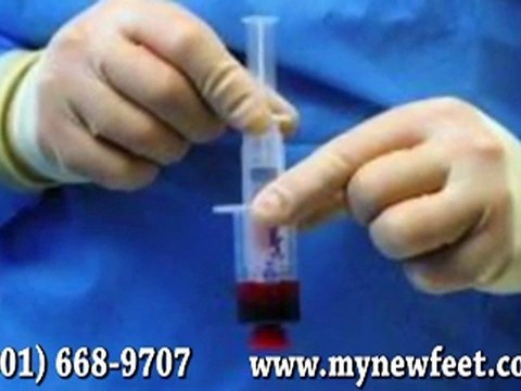Platelet Rich Plasma (PRP) Therapy - Podiatrist Frederick, Germantown Hagerstown, MD