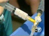 Foam Sclerotherapy ABC News