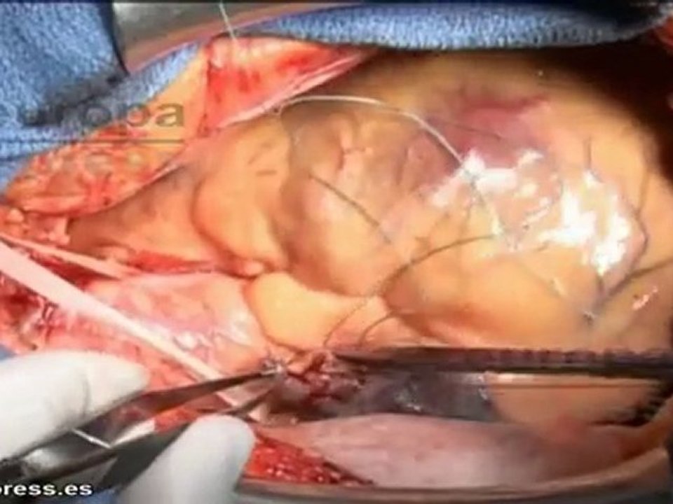 Primer corazón artificial en Cataluña