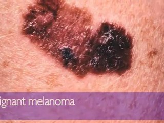 CRUK | Policy | Children and sunbeds