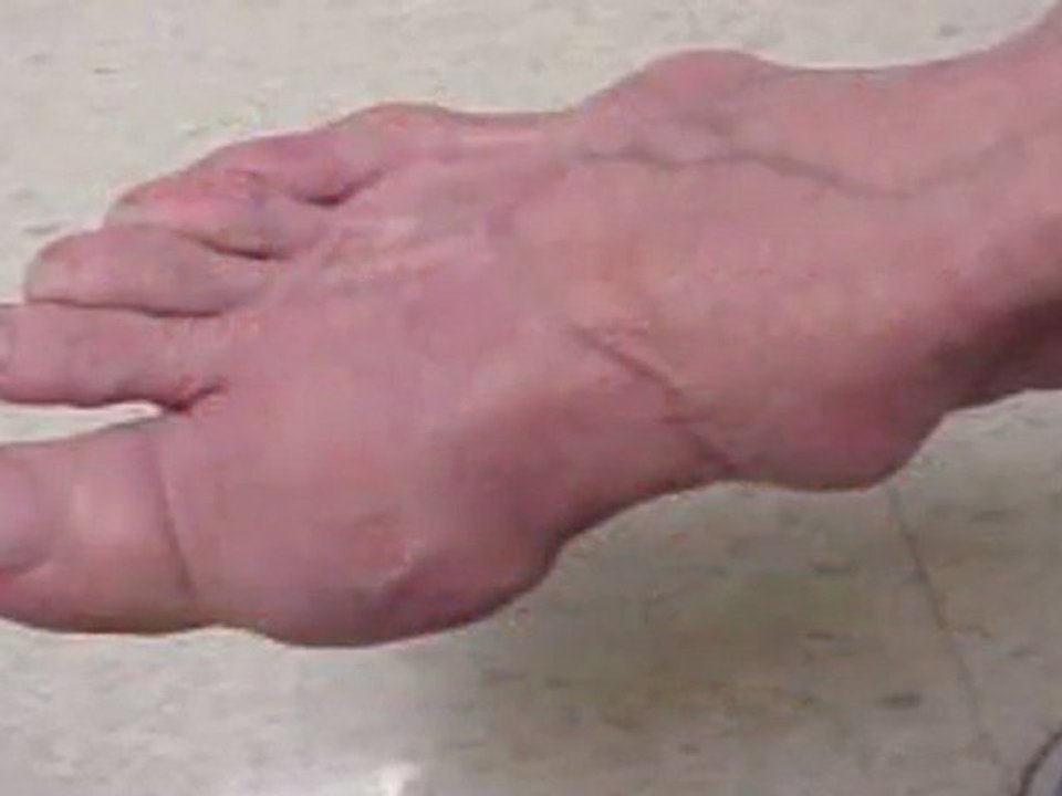 How To Cure Gout Without Medication - How To Stop Gout Pain Naturally