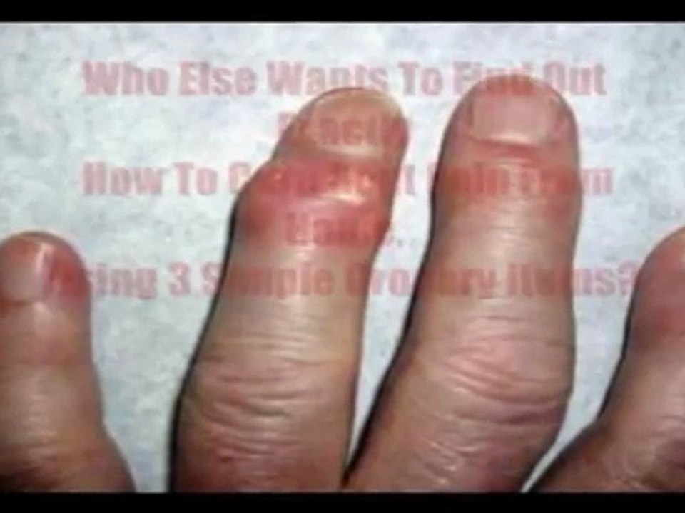 Natural Remedies For Gout Pain - how to remove gout crystals