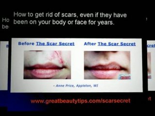 How to get rid of scars - remove scars naturally. How to cure scar naturally.