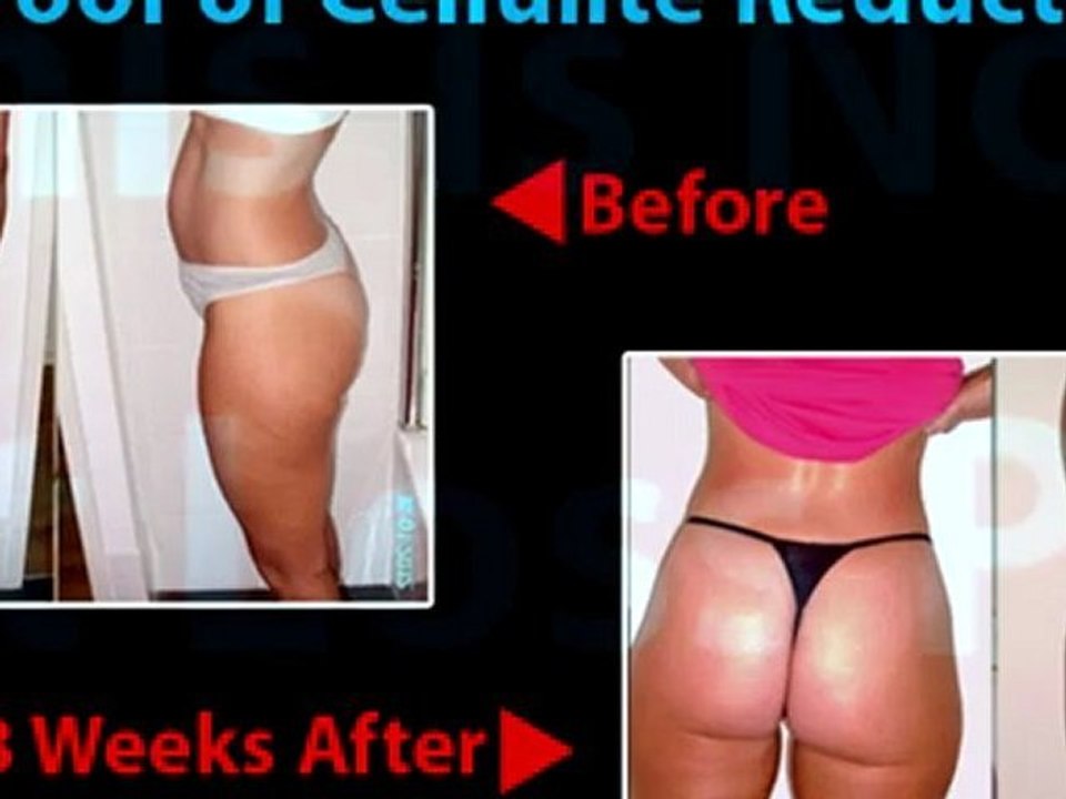 Cellulite Reduction Method