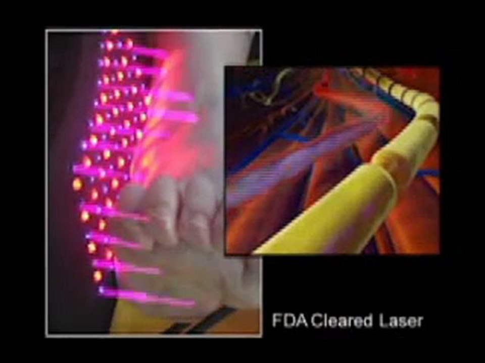 Peripheral Neuropathy Treatment - Atlanta, GA