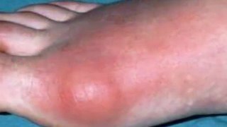 How To Get Rid of Gout Pain at Home - gout pain relief home remedies