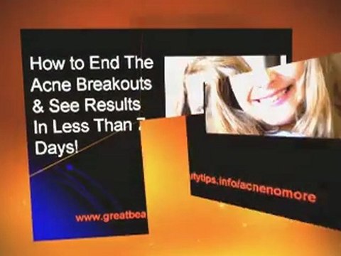 How to remove acne on face fast. How to stop acne breakouts naturally.