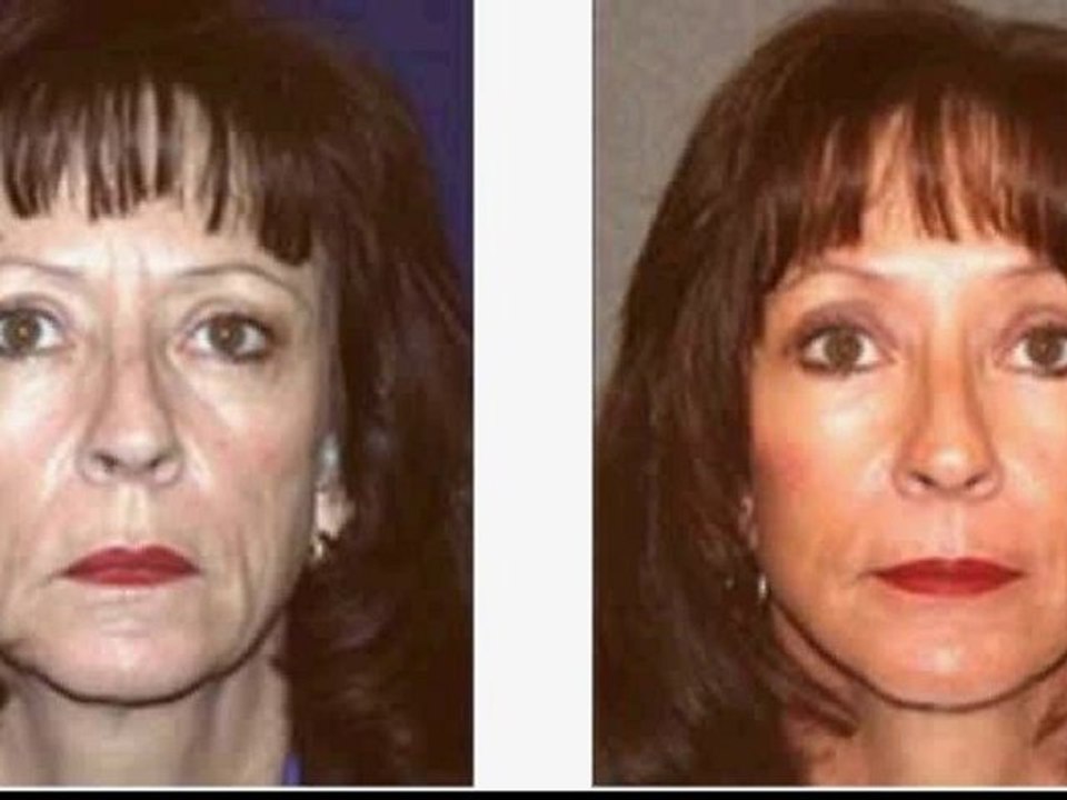 Images before and after a facelift