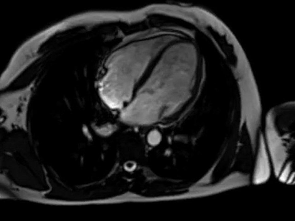 irm coeur cine - Imagerie médicale cardiologie