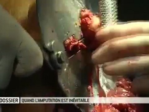 Quand l'amputation s'impose... Allodocteurs