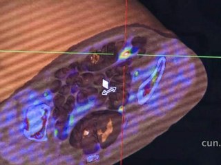 La Clínica Universidad de Navarra adquiere un nuevo equipo PET