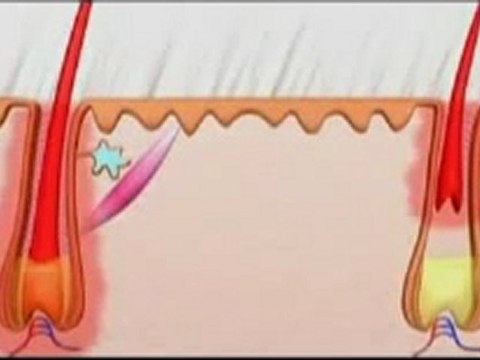 IPL Laser Hair Removal - Fine Lines MedSpa