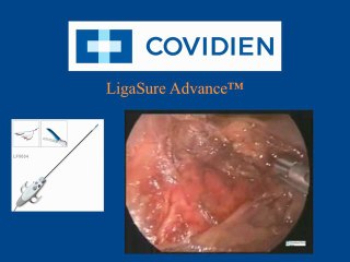 Ligasure Advance Laparoscopic Surgery