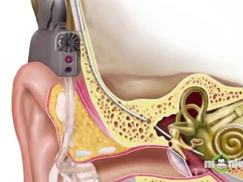 Understanding Hearing Loss